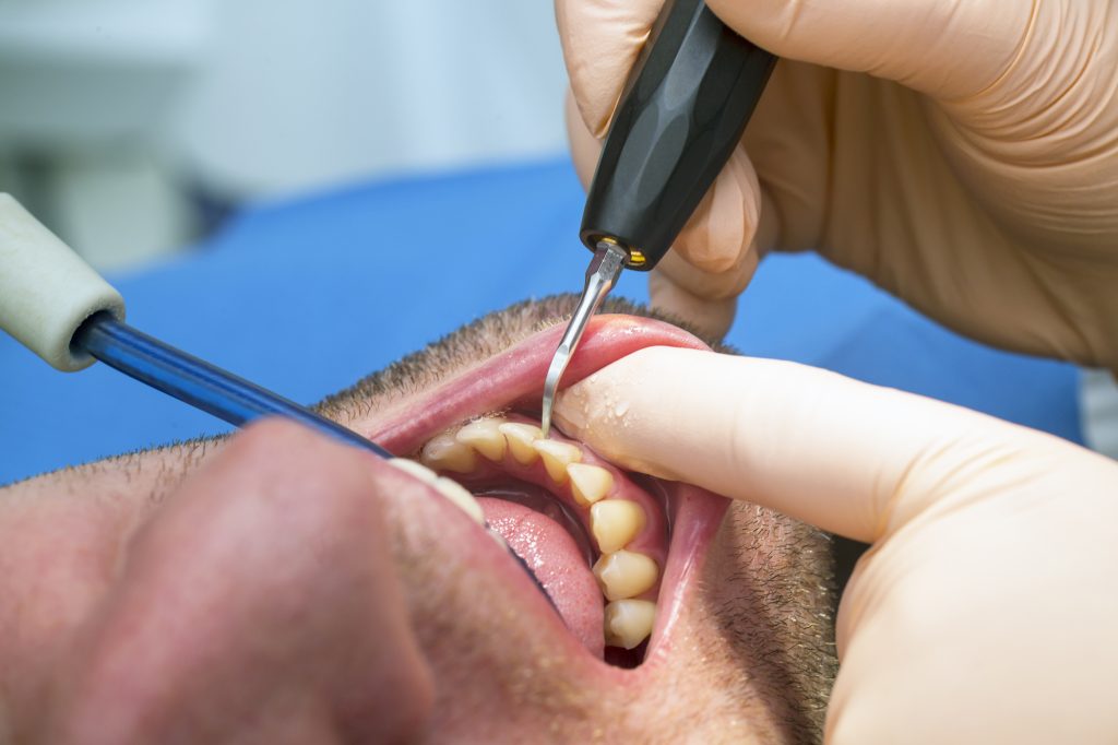 tratamiento de gingivitis y periodontitis