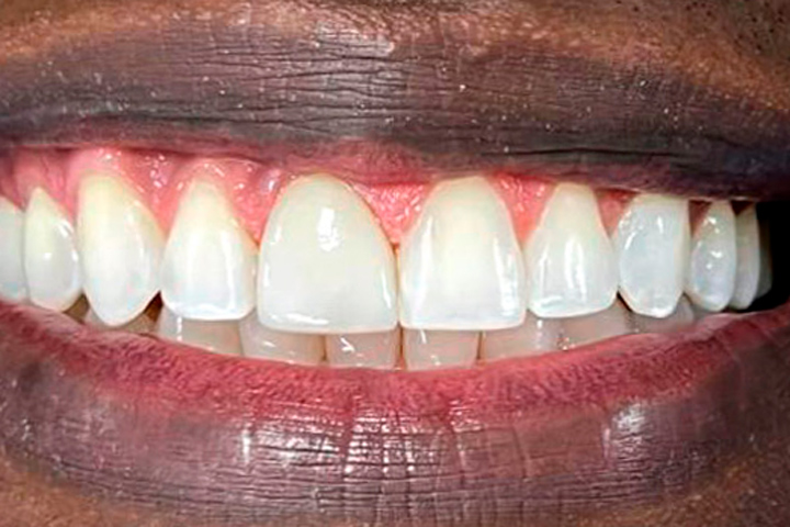 diseño de sonrisa carillas dentales en cerámica, fotografía de paciente antes del procedimiento