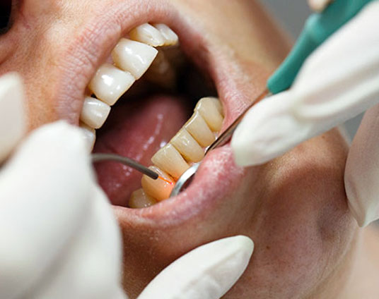 gingivitis y periodontitis