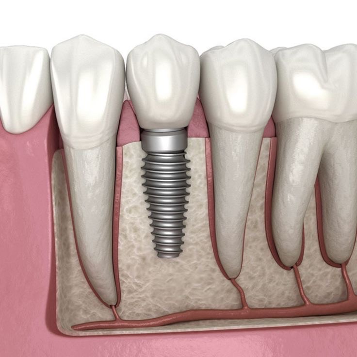 corona dental fija sobre implante dental