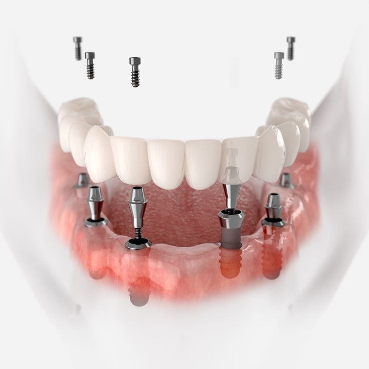 prótesis hibrida sobre implantes dentales