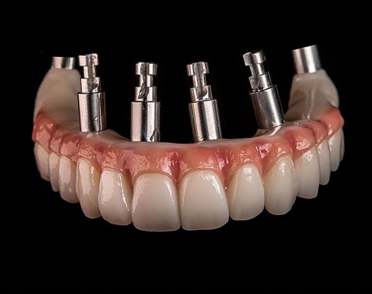 prótesis fija sobre implantes dentales