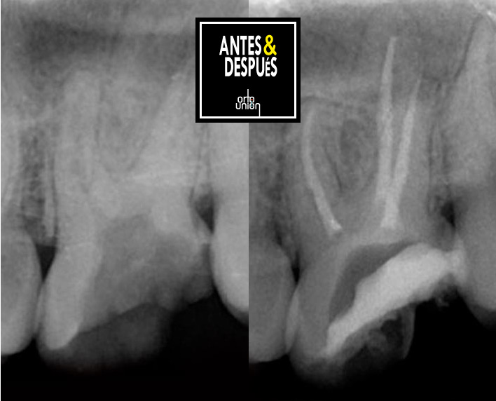 endodoncia multirradicular antes y después