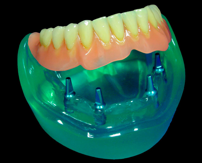prótesis sobredentadura sobre implantes dentales