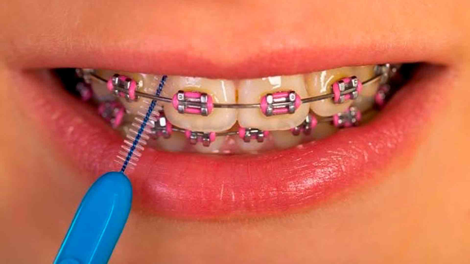 cepillarse los dientes con brackets cepillo interproximal