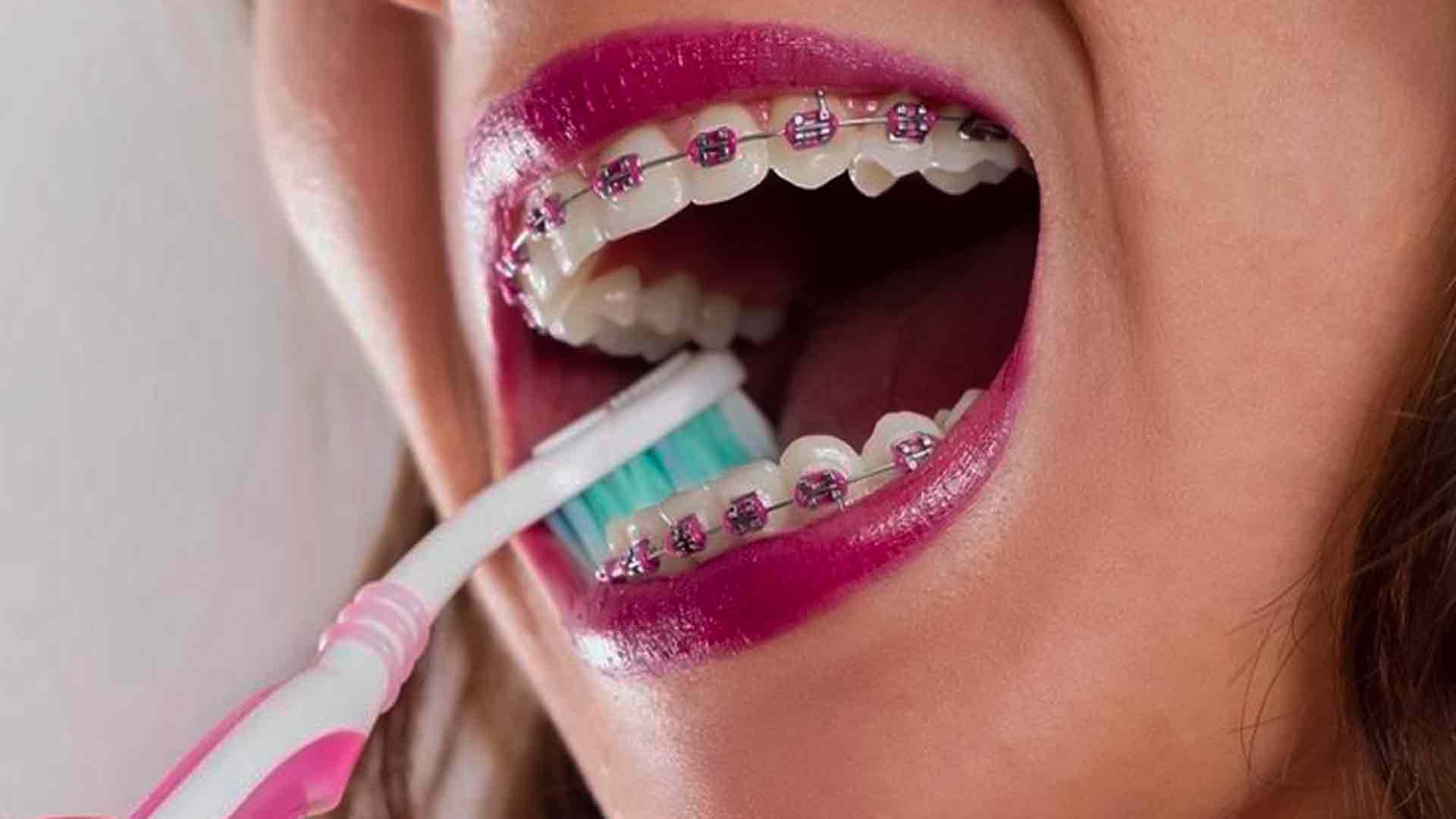 como cepillarse los dientes con brackets